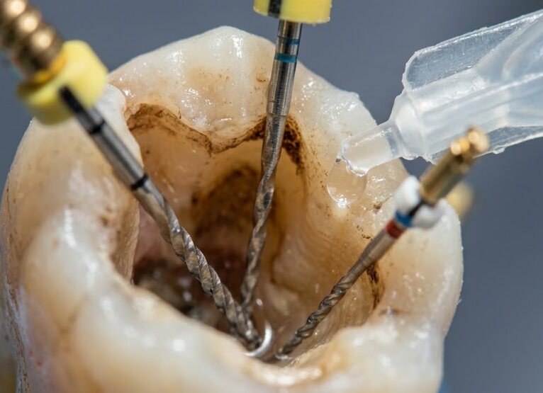 Limas de endodoncia dentro de los conductos radiculares junto a la irrigación que desinfecta el interior del diente