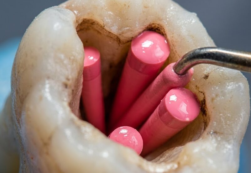 Conductos radiculares sellados con puntas de gutapercha al terminar la endodoncia