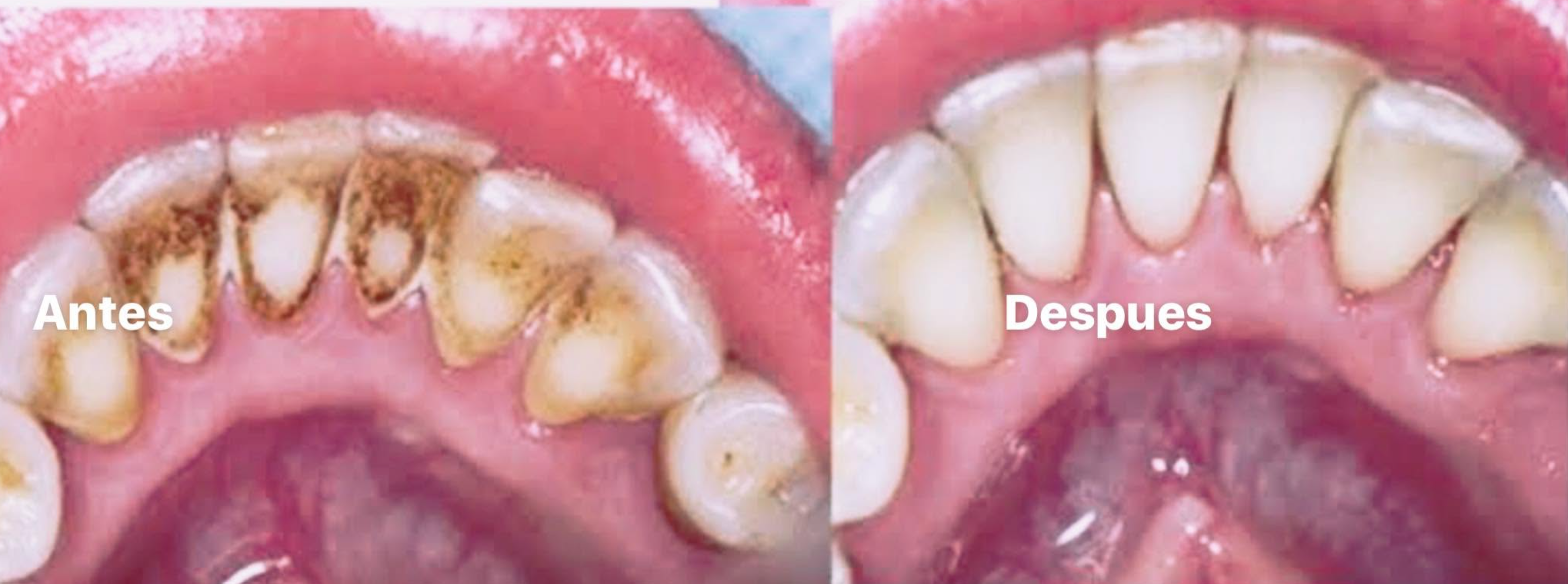 Caso de limpieza dental antes y después realizado en Biodont