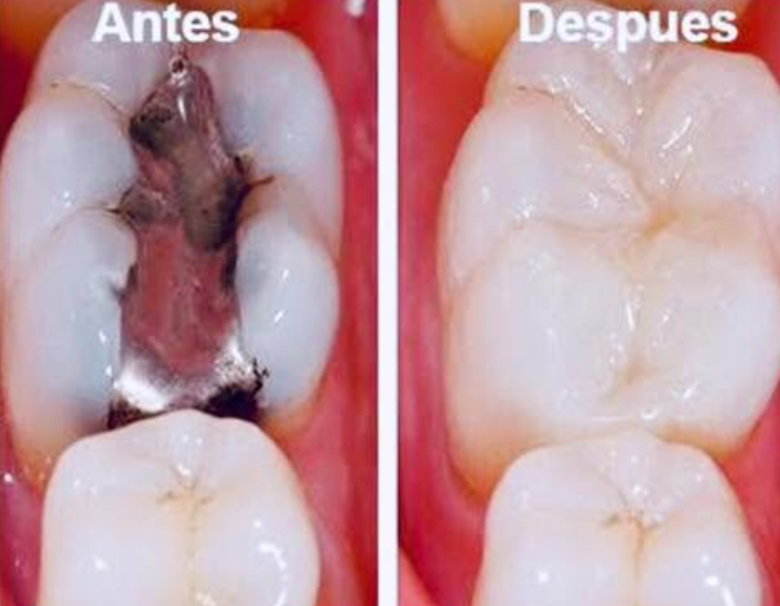 Caso clínico dental tratado en Biodont Consultorio Odontológico