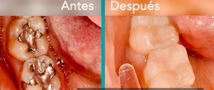 Resultado de tratamiento de endodoncia realizado en Biodont Consultorio Odontológico